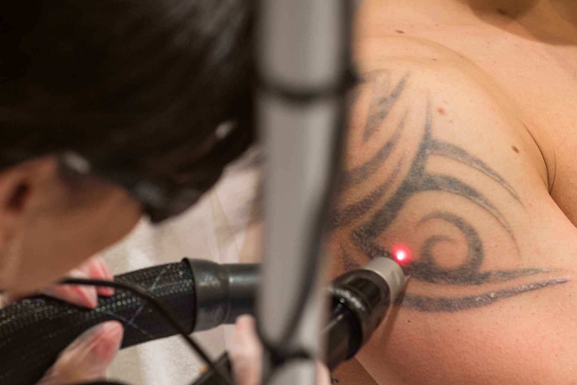 Non laser tattoo removal dangers