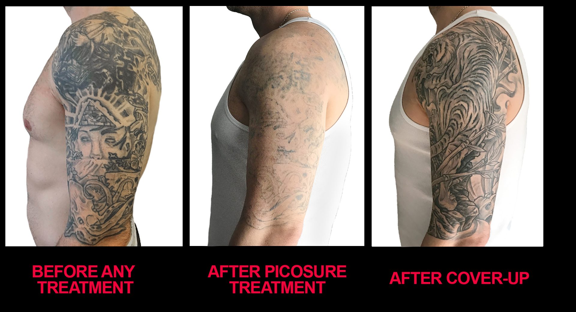 Laser tattoo removal or cover up