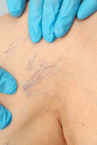 Spider Vein Removal Packages