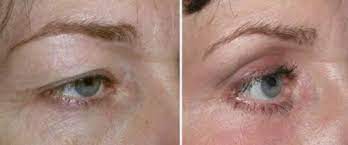 PlexR Plasma Fibroblast Skin Tightening